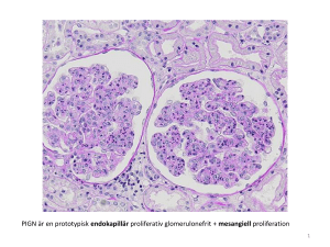 PIGN är en prototypisk endokapillär proliferativ glomerulonefrit +